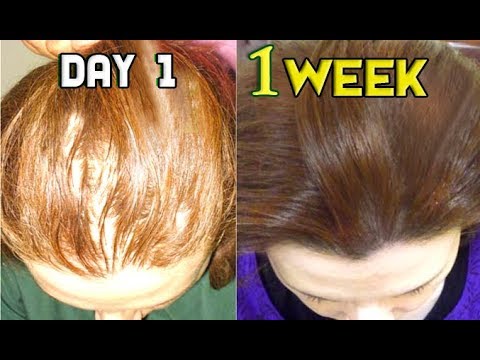 With This Kitchen Ingredients Turned her Thin hair To Thick hair in 1 week Super Fast HAIR GROWTH
