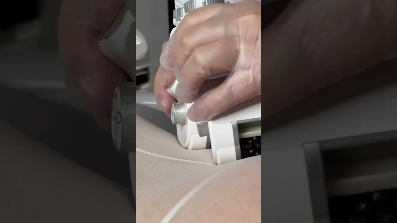 Icoone Laser от 1000 руб | Центр красоты и здоровья Бьюти Бриз