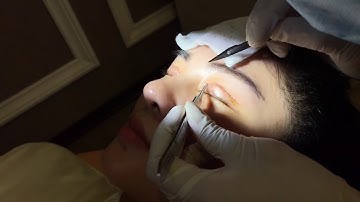 Theo Dõi Nếp Mí Vừa Cắt Chỉ Xong Tại Dr.Hải Lê.