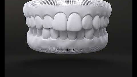 Hiệu quả của khay chỉnh nha Invisalign - Răng chen chúc