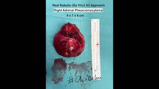 Real Robotic (Da Vinci Xi) Right Adrenalectomy for large (9x7x6 cm) Pheocromocytoma