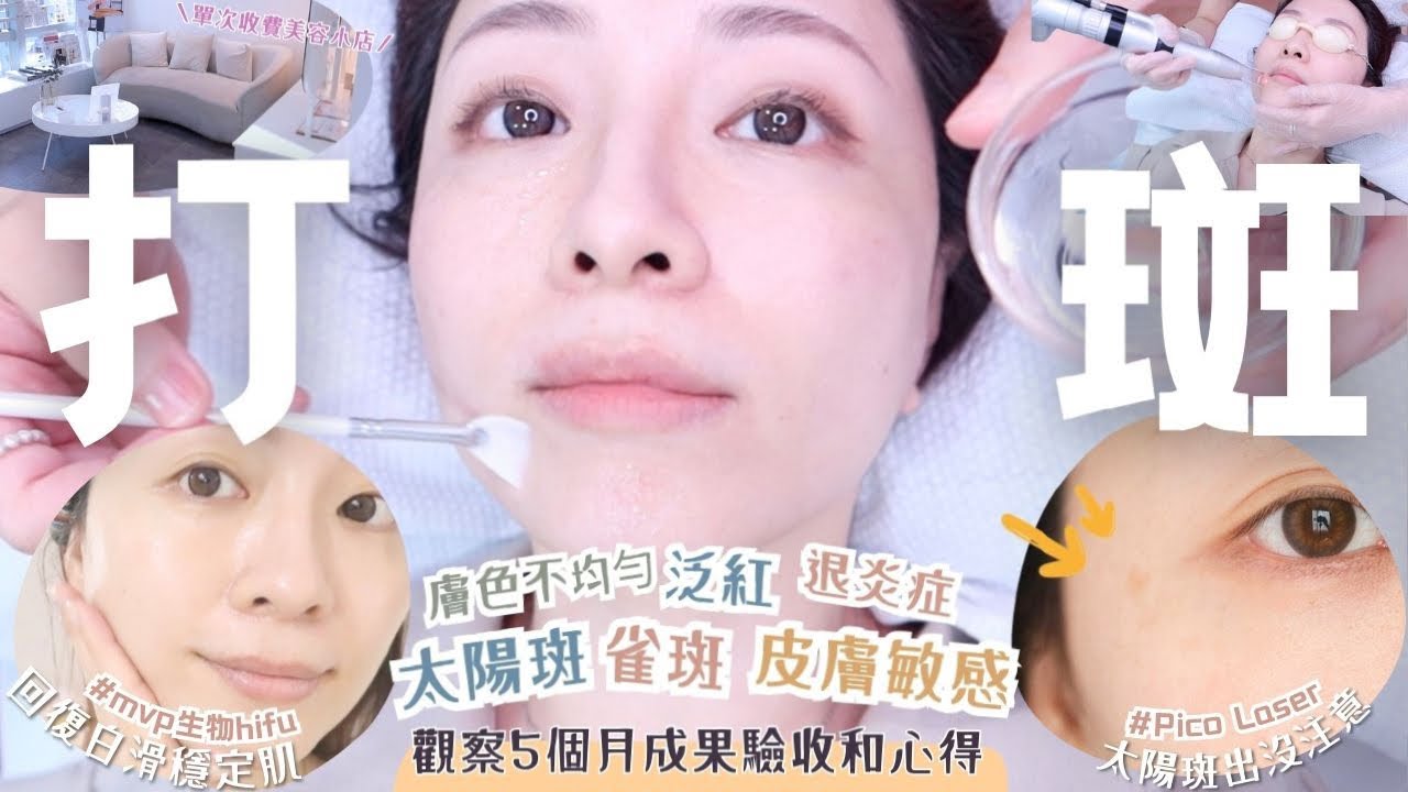 私分享打斑5個月後成果┃瑞士MVP生物療程抗敏效果超驚喜～♥┃單次收費小店及必買產品推介┃Katy Beauty 縮圖