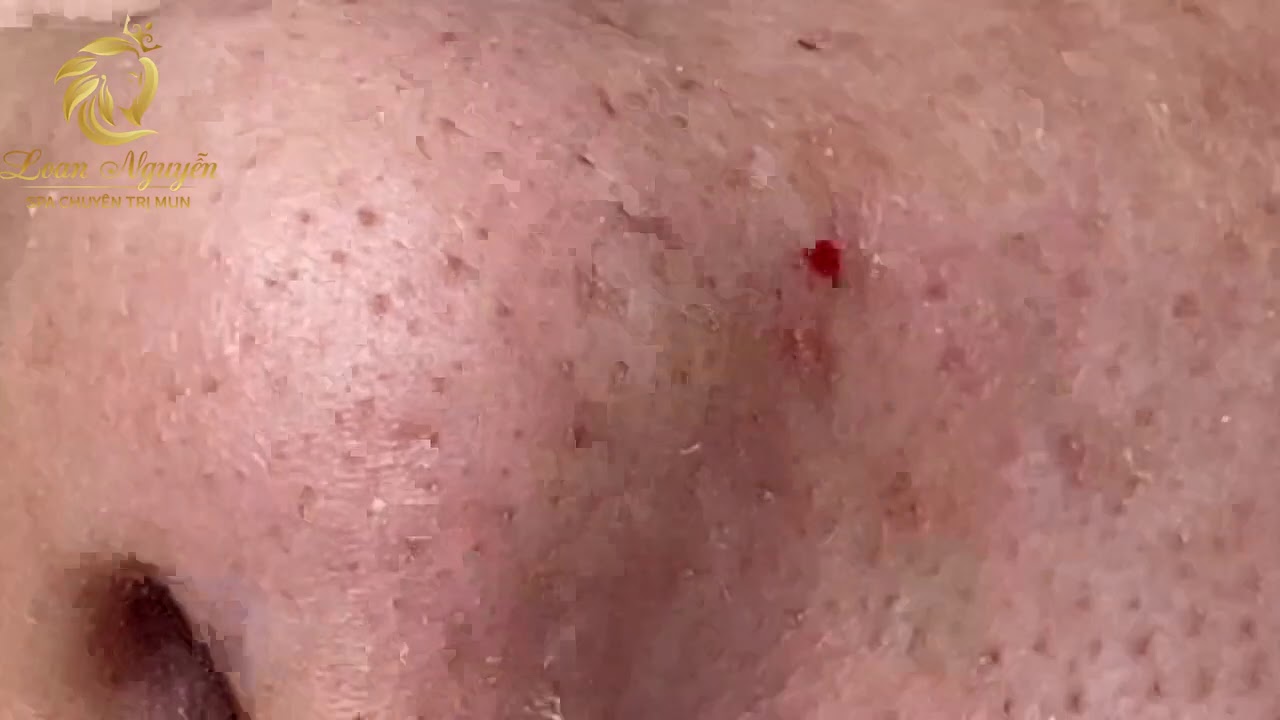 Blackheads extraction (413) | Loan Nguyen