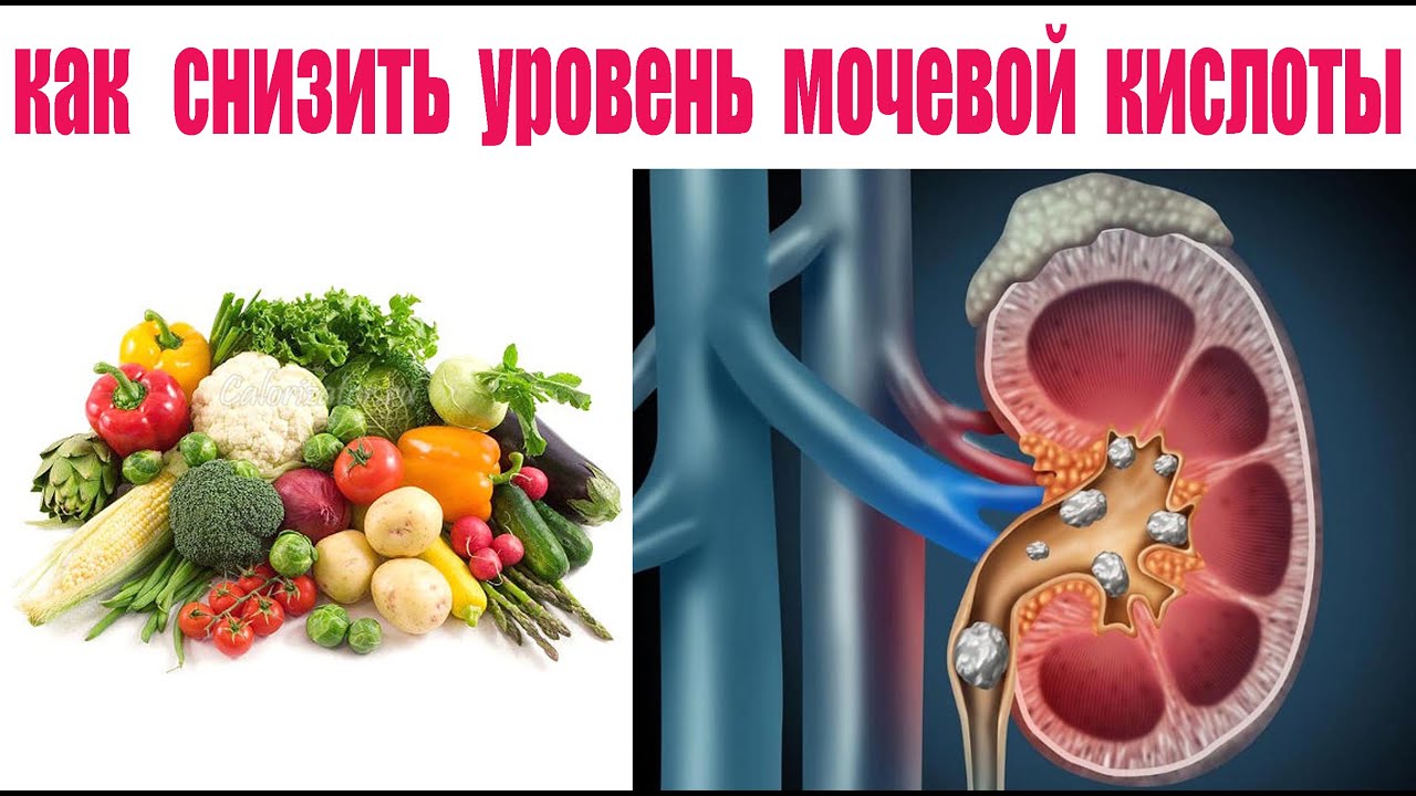 Как снизить уровень мочевой кислоты и вылечить подагру - YouTube