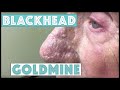 A goldmine of blackhead  whitehead extractions