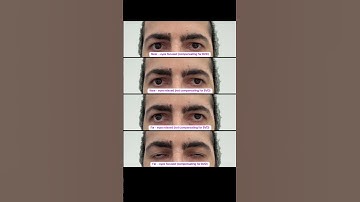 Watch how my eye alignment changes depending on where I look and how much I have to compensate for