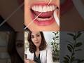 How Does Flossing With A Dental Bridge Look Like?!