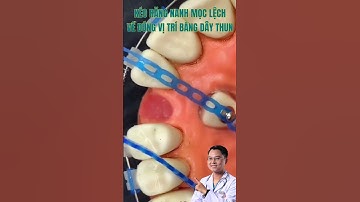 Quá trình kéo răng nanh mọc lệch về đúng vị trí | Bác sĩ Cường #bacsicuong #short