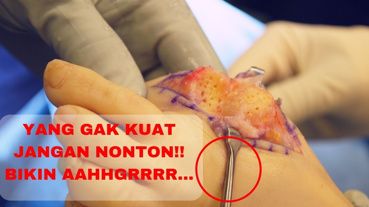 Operasi Pengangkatan Benjolan Asam Urat Dikaki
