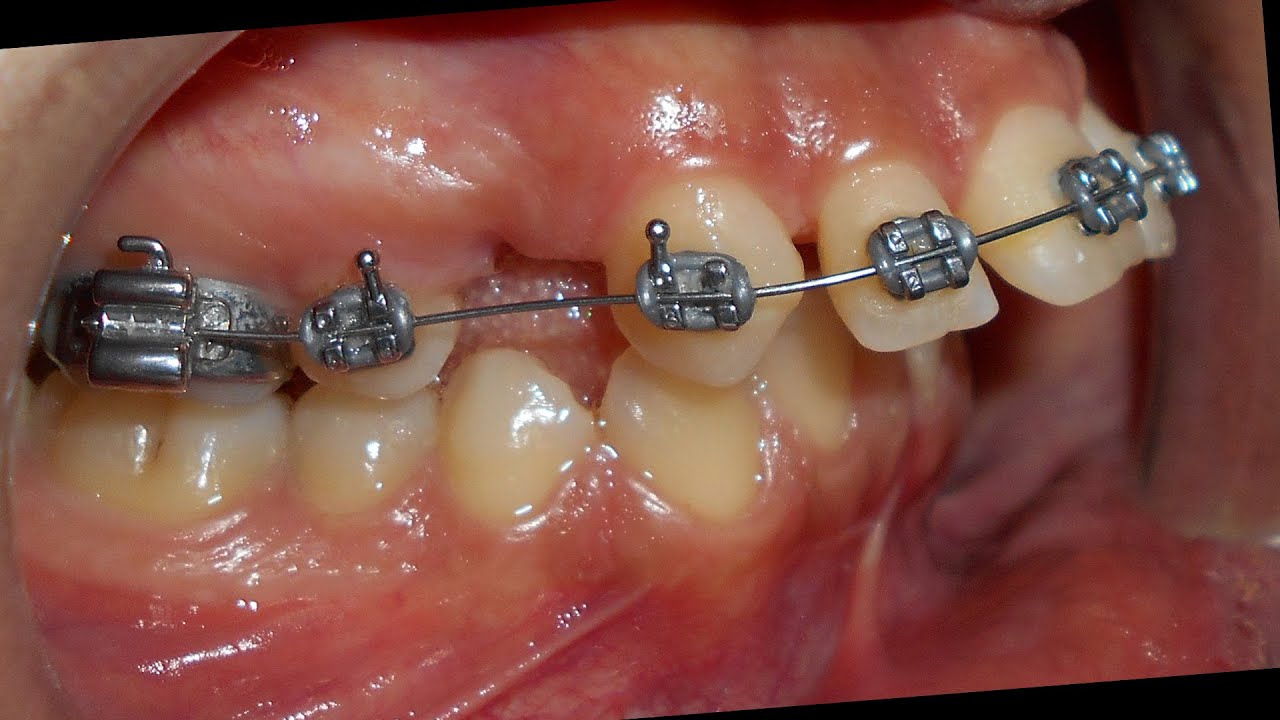 حالة صنف ثان نموذج أول مع بروز قاطعي كبير، عولجت من خلال التمويه التقويمي - الدكتور محمد يونس حجير