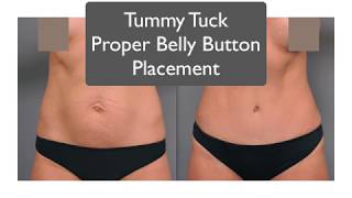 Belly On Placement Tummy Tuck Specialist Explains