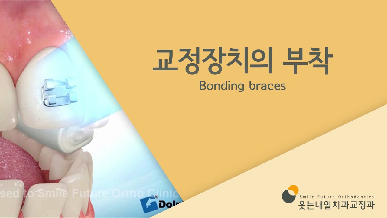 교정장치의 부착 (Bonding braces) YouTube