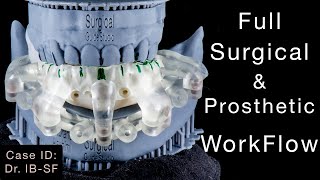 Fixed Teeth in a 1 hr | Stackable Magnetic 🧲 Prosthesis & Surgical Guide