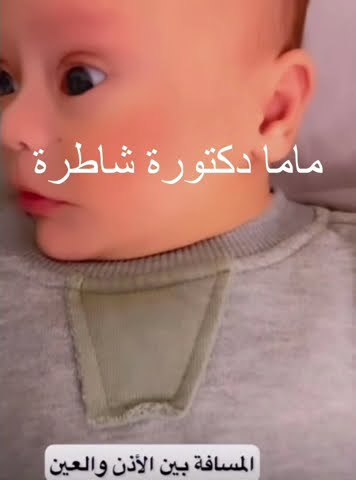 علامات تدل على اصابه المولود بمتلازمة الداون