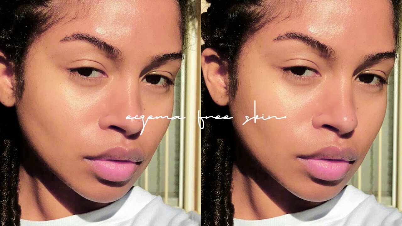 completely heal your eczema. // 