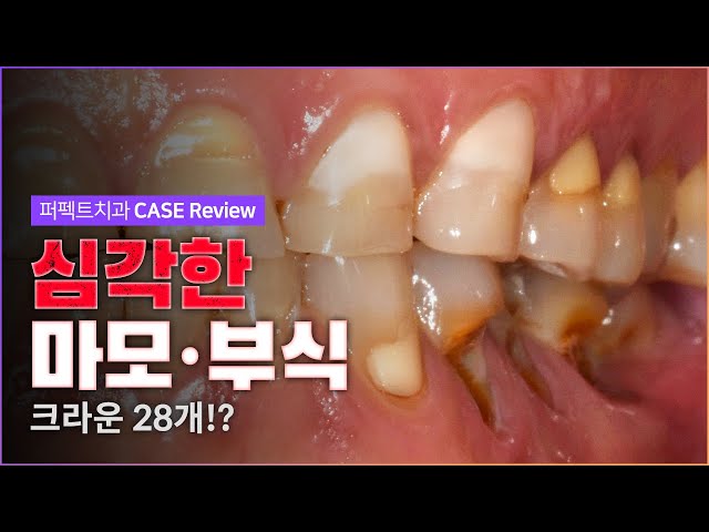 심각한 치아 마모&부식😱 | 지르코니아 크라운 전악보철 (feat.임플란트)