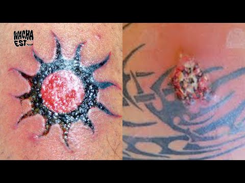 Vídeo: Explosión Del Tatuaje: Apariencia, Tratamientos Y Más
