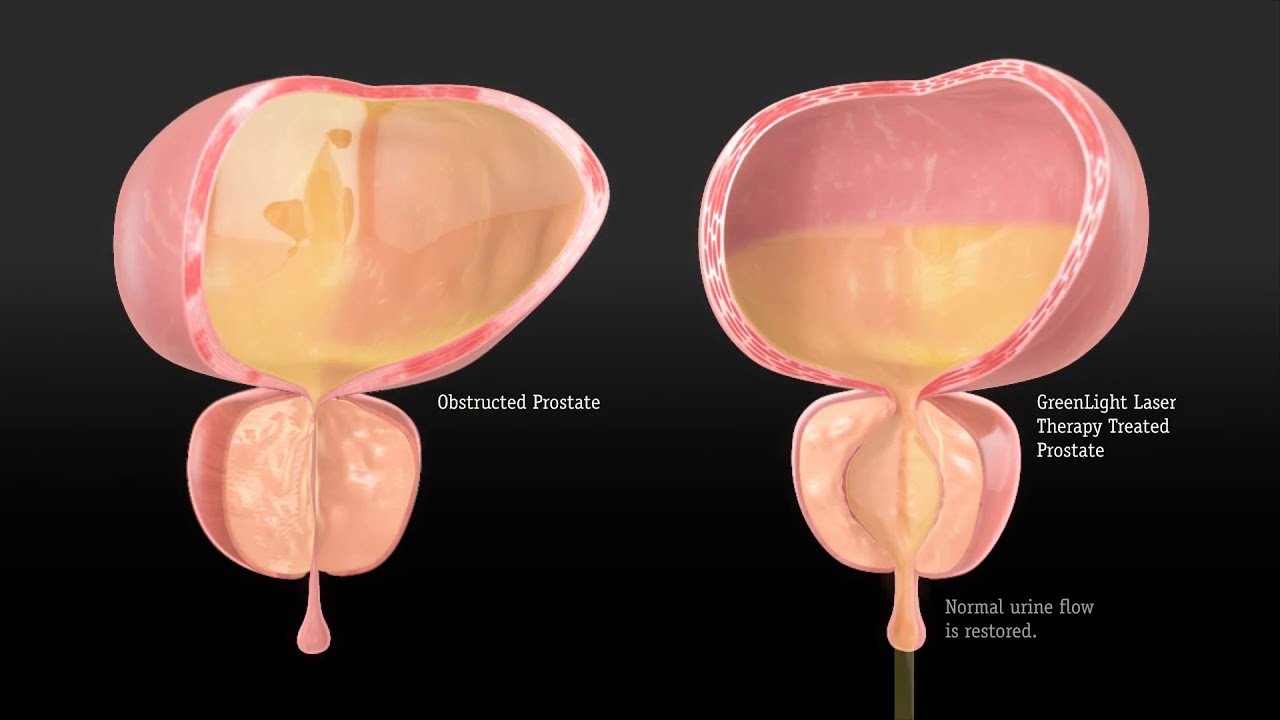 Green Light Laser Prostate Surgery Bleeding Shelly Lighting