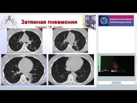 Рентгенодиагностика пневмоний у взрослых