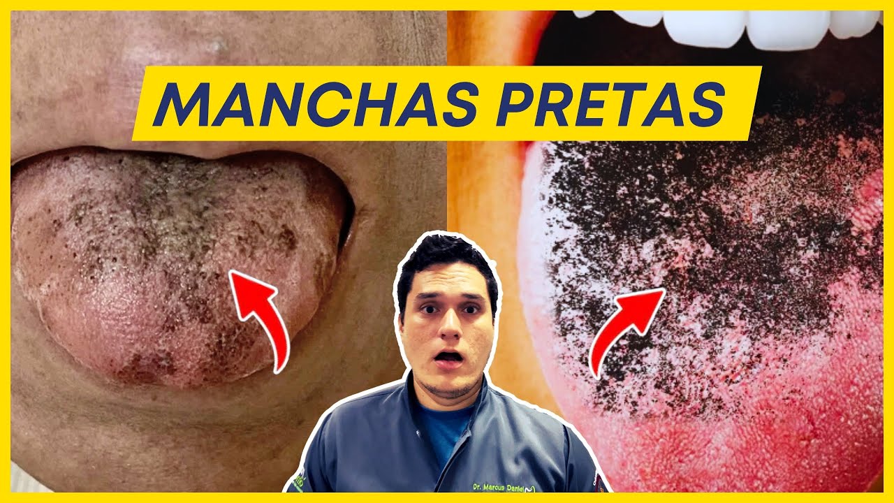 Língua com manchas pretas: O que pode ser? - YouTube