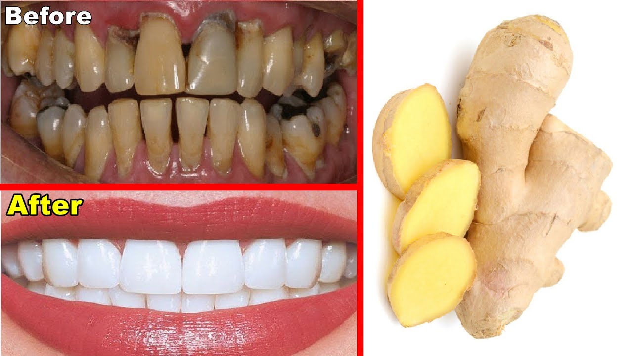 Magical Teeth Whitening Remedy, Get whiten Teeth at home in 4 minutes ...