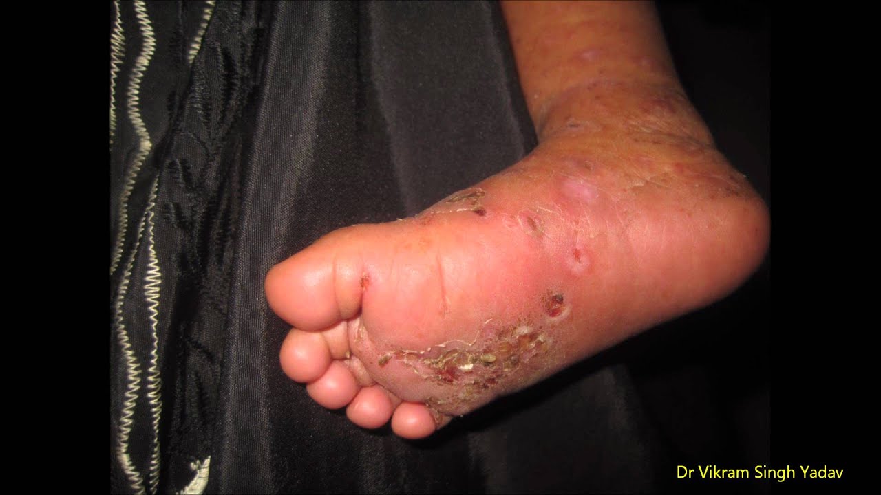 Scabies In Infant - YouTube