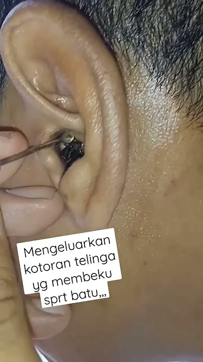 Proses Pengambilan Kotoran Telinga Yang Membatu | Serumen Prop