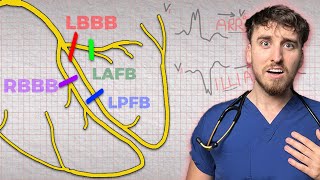 Bundle branch blocks - how to never forget them!