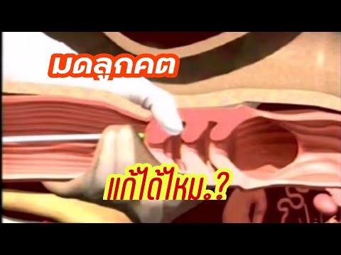 มดลูกคตเป็นยังไงทำไมเซิงไม่ติด..?