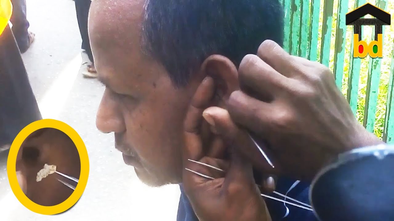 Impacted Chunky White Earwax Removal by Expert Street Ear Cleaner II