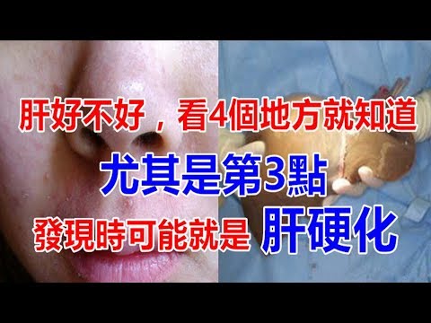肝好不好，看外表四個地方就知道，尤其是第三點，發現可能就是肝硬化了！