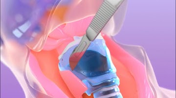 Laryngectomy   surgical deconstruction