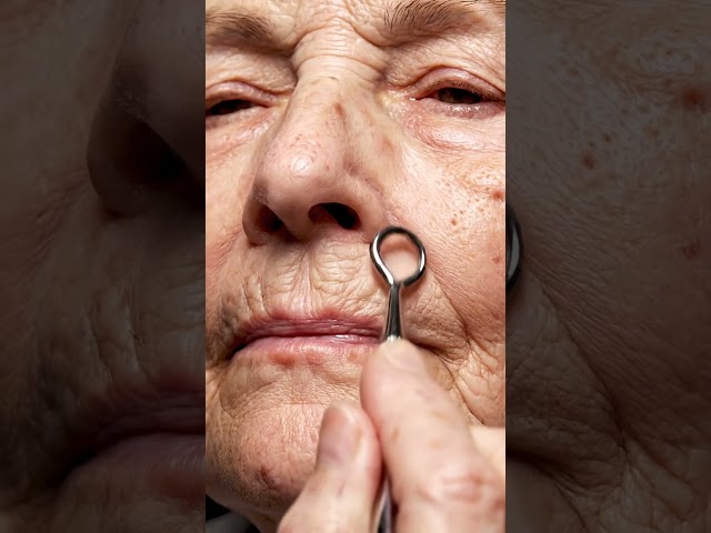 Entire Face Cleaned in One Session