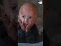 What Is Progeria What Is Progeria
