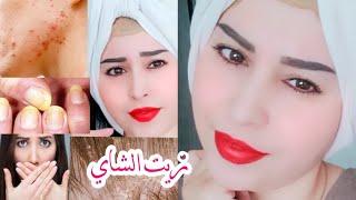 تجربتي مع زيت الشاي لحب الشباب وفطريات الشعر والاظافر