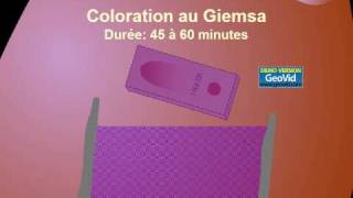 Diagnostic Du Paludisme