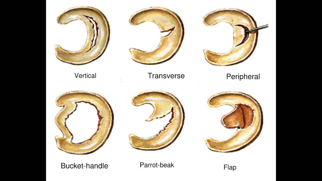 الدكنور مهند الزعبي اخصائي جراحة العظام و المفاصل يتحدث عن تمزق الغضروف الهلالي و الاصابات الرياضية