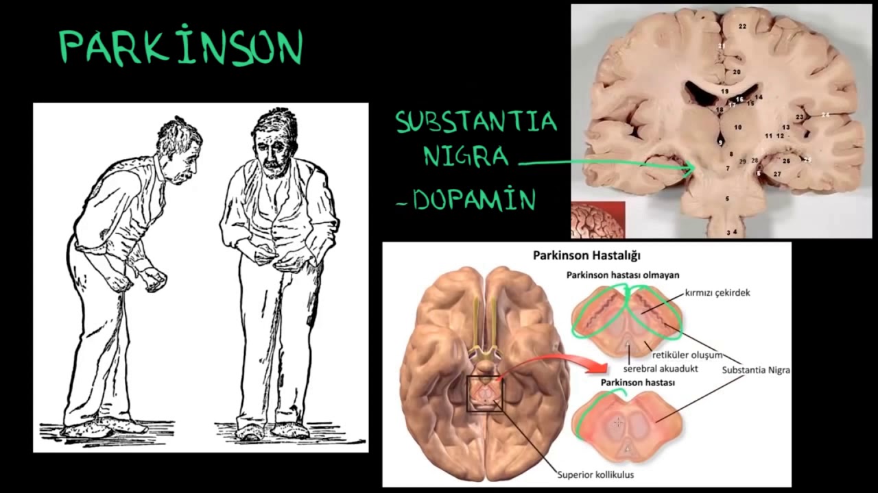 Parkinson Hastalığı'nın Biyolojik Temelleri (Psikoloji / Akıl Sağlığı) (Sağlık Bilgisi ve Tıp)