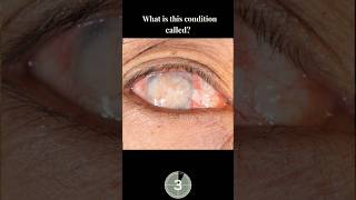Eye Disease Knowledge 🙀#eyes #eyecareprofessional #eyespecialist #optometrist #eyediseases