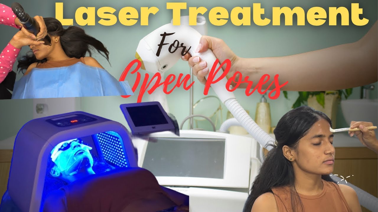 My First Laser Treatment for Open Pores | Honest Results + Before/After.   #lasertreatment