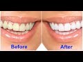 How to Naturally Whiten Teeth At Home in 3 – 5 Minutes/Teeth Whitening At Home