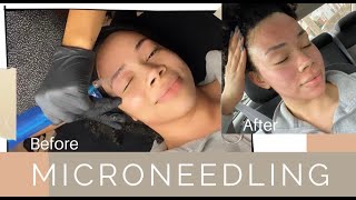 MICRONEEDLING | Does it HURT? Is it WORTH it?