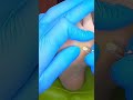 大きな魚の目がポロリ【ドイツ式フットケア】