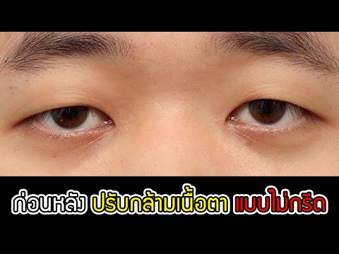 รีวิวเคสทำตาแบบไม่กรีดของคุณผู้ชาย!! 👀