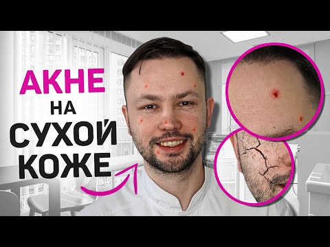 Почему АКНЕ на сухой коже? Что делать? Ответ врача