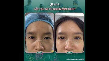 HÌNH ẢNH TRƯỚC VÀ SAU KHI CẮT MÍ 5D TẠI PHÒNG KHÁM THẨM MỸ HILA | DR HIẾU NGUYỄN