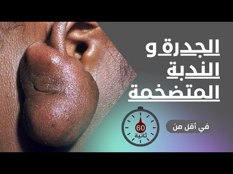 فيديو: ما يقتل جيكوس؟