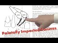 How to Prevent Palatally Impacted Canines (ref. Ericson and Kurol)