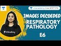 IMAGES DECODED | EPS 6 | RESPIRATORY PATHOLOGY | MUST KNOW IMAGES IN PATHOLOGY | DR. PREETI SHARMA