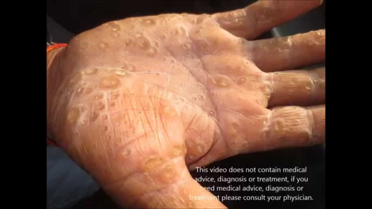 Keratosis Palmaris et Plantaris: Overview, Diffuse ...